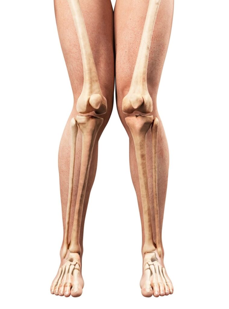 koślawość kolan