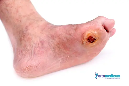 Zespół stopy cukrzycowej, rana na stopie