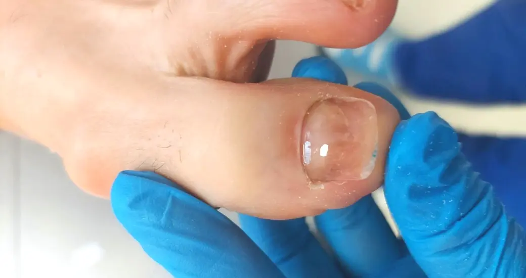 Rekonstrukcja paznokcia u nóg – kiedy jest potrzebna i na czym polega?