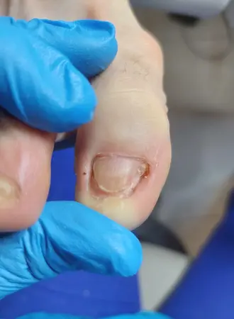 rekonstrukcja paznokcia nog pacjentka