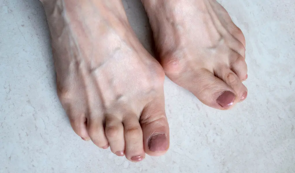 Damskie stopy z haluksami (wystająca kość od wewnętrznej strony stóp).